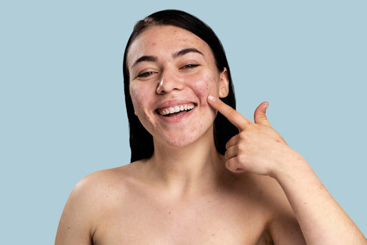 Acne del viso: cos’è, cause, tipologie e come trattarla con efficacia